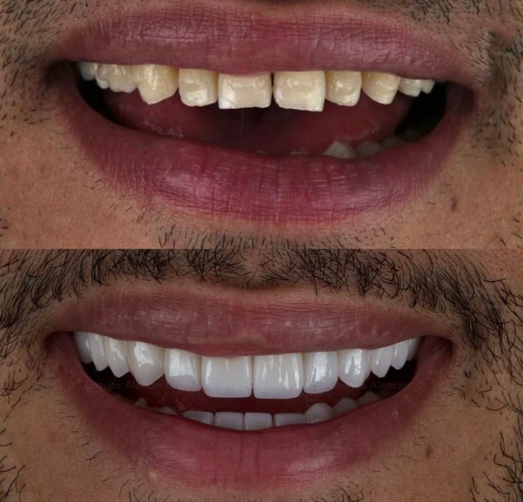 Transformando Sorrisos: Descubra o Poder das Lentes de Contato Dental